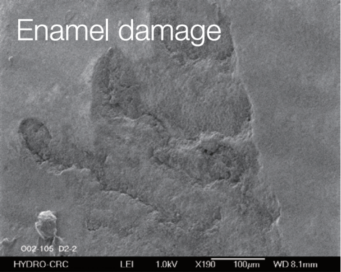 Enamel Damage