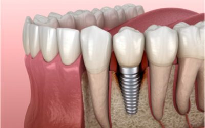 4 tips to keep your dental implant safe from peri-implantitis