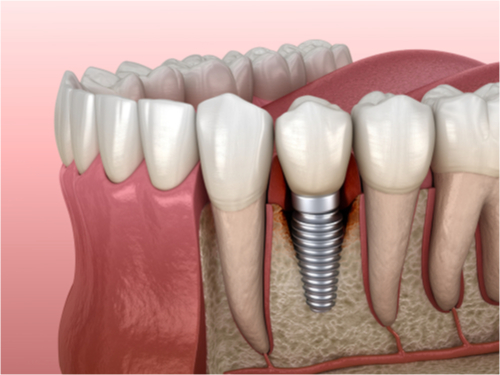 4 tips to keep your dental implant safe from peri-implantitis