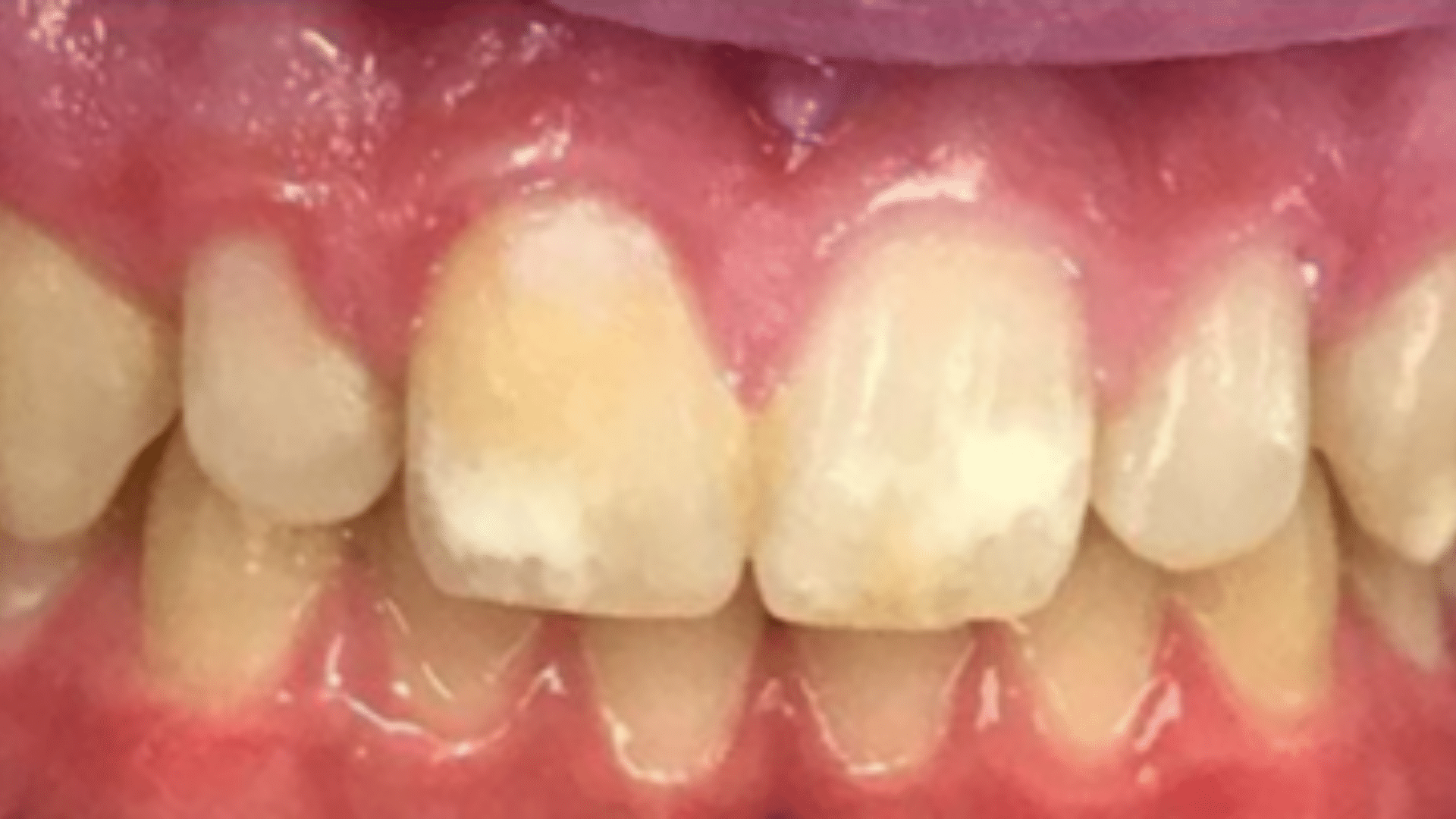 After No whitening performed