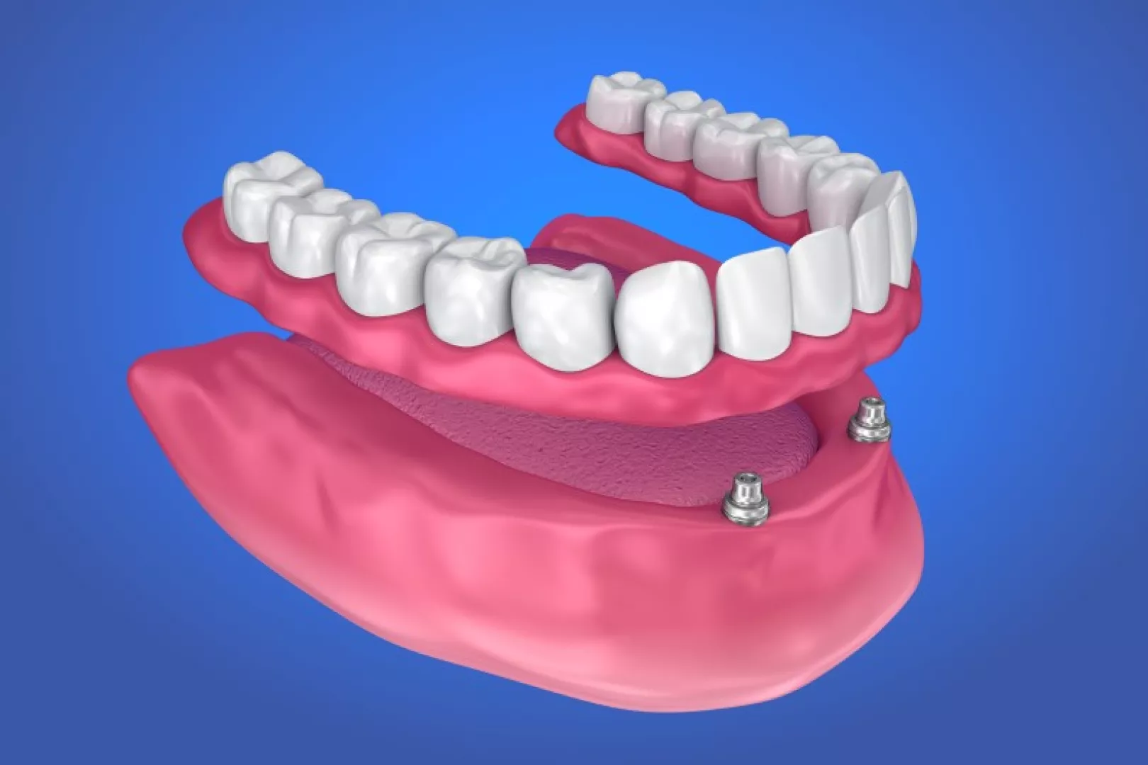 thumb_Content Images_2-implant-overdenture_w1920_h1080_frectangle