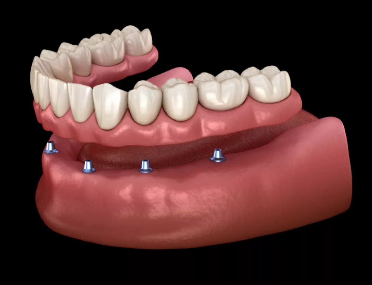 thumb_Content Images_4-implant-overdenture_w1920_h1080_frectangle