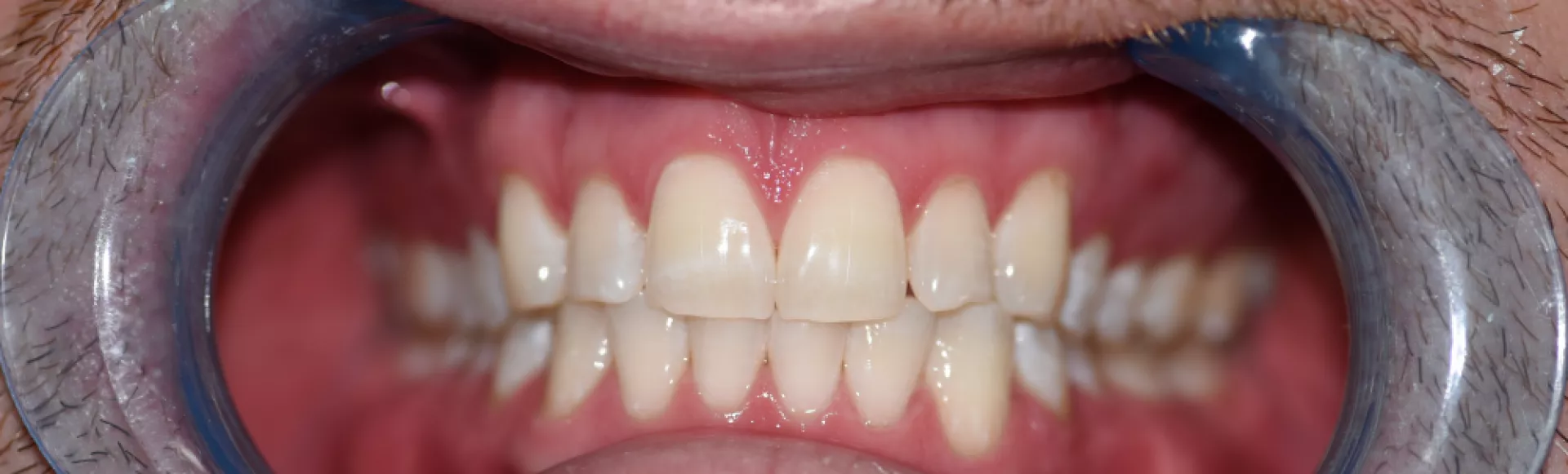 zoom whitening