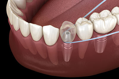 Floss Around Your Implant 