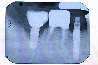 Computer generated picture of Peri-Implantitis