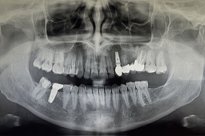 X-ray of an Implant Bridge