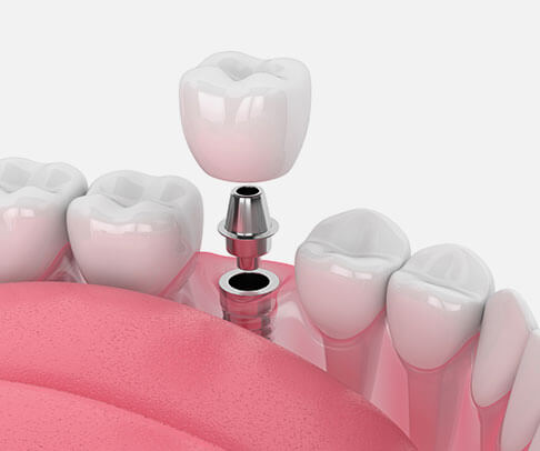 dental implants