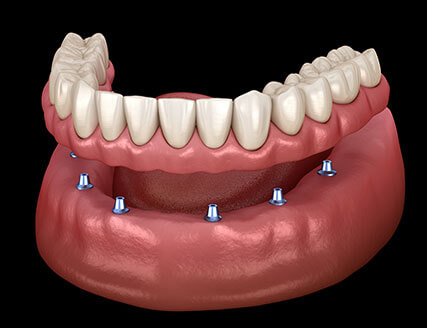 Visit www.nsbrisbanedentalimplants.com.au