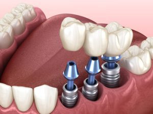 dental implanted beneficial advantages balmoral