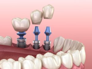 Cost-Of-Single-Tooth-Implants-placement-balmoral