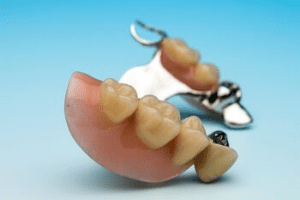 dental implants cost bulimba