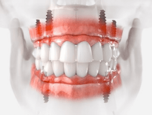 dental implants costs bulimba