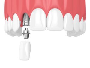 bali dental implant procedure balmoral