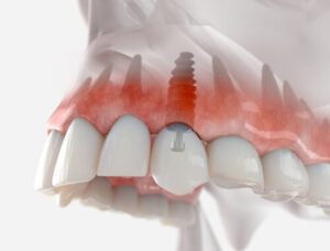 dental implant thailand illustration