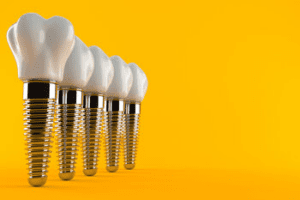 implant placement bulimba