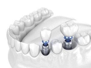 Dental Implant Vietnam types