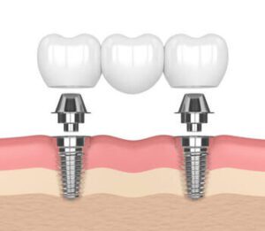 Dental Implants Vs Bridge comparison