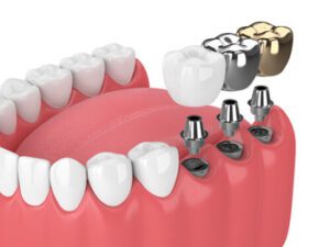 Dental Implants Vs Bridge types