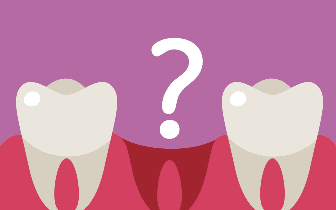Dental Implants vs. Bridge: Which is the Superior Choice?