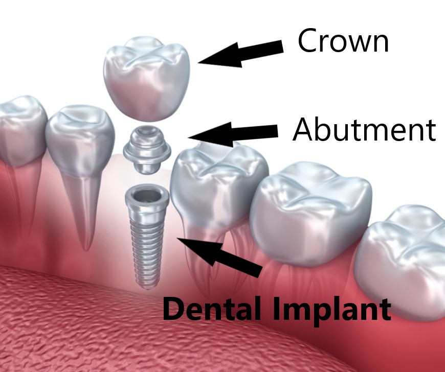 Implant Description (1)
