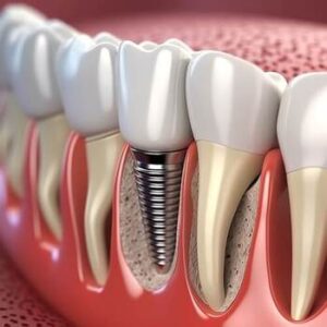Single Tooth Implant Cost Australia image