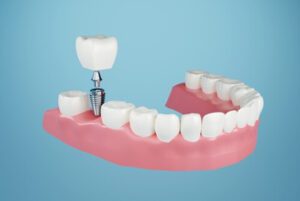 Affordable Dental Implants illustration bulimba