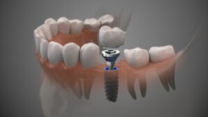Affordable Dental Implants single bulimba