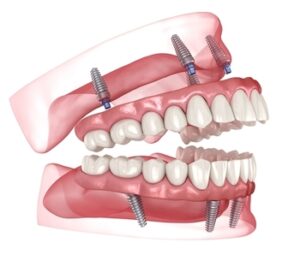Cost-For-Full-Mouth-Dental-Implants-image-bulimba