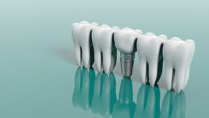 Cost Of Dental Implants In Australia images dubbo