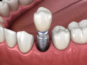 cheap dental implant procedure bulimba