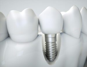 dental-implants-cost-india-illustration-bulimba