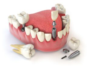 dental-implants-cost-india-number-of-posts-bulimba