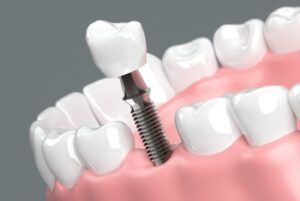 Dental Insurance That Covers Implants materials balmoral