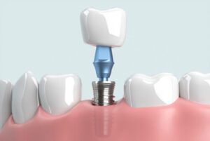 Dental Insurance That Covers Implants placement balmoral