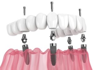 Full-Mouth-Dental-Implants-Cost-Thailand-illustration-balmoral