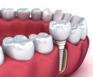 DentalimplantsMELBOURNENS.COM.AU 