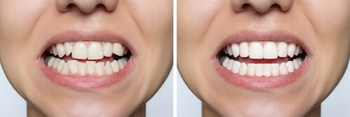 Cost Of Invisalign Australia before after balmoral