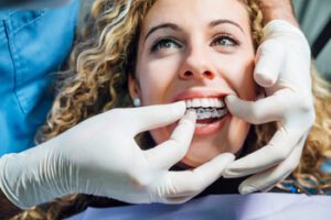 How-Does-Invisalign-Work-placement-balmoral