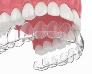 3d,Render,Of,Upper,Jaw,With,Invisalign,Removable,Retainer,Over