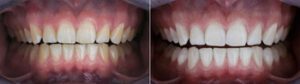 Cost Of Dentures For Pensioners look