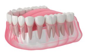 How Much Does a Root Canal Cost crack
