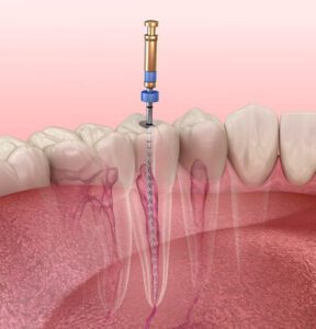 Root Canal Before and After procedure