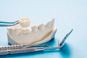 Root Canal Recovery Time crown