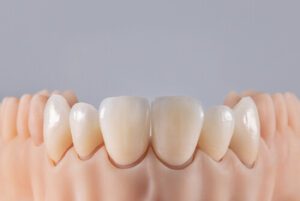 What Is A Dental Crown use