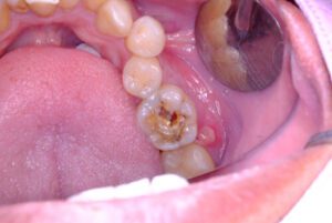 What Is a Tooth Filling decay