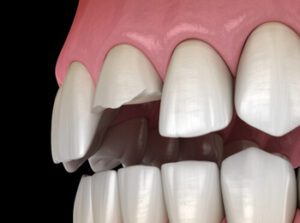 tooth cap vs crown broken