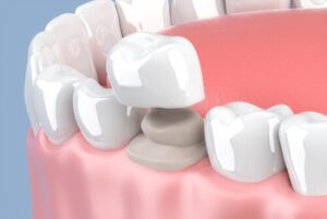 tooth cap vs crown placement