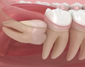 Why Does Wisdom Tooth Pain Come and Go impacted
