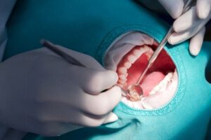 How to Stop Throbbing Pain After Root Canal treatment