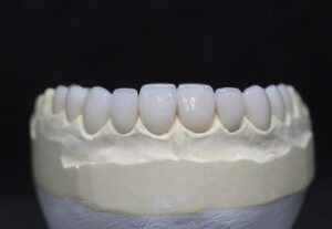 Tooth Crown Pain set